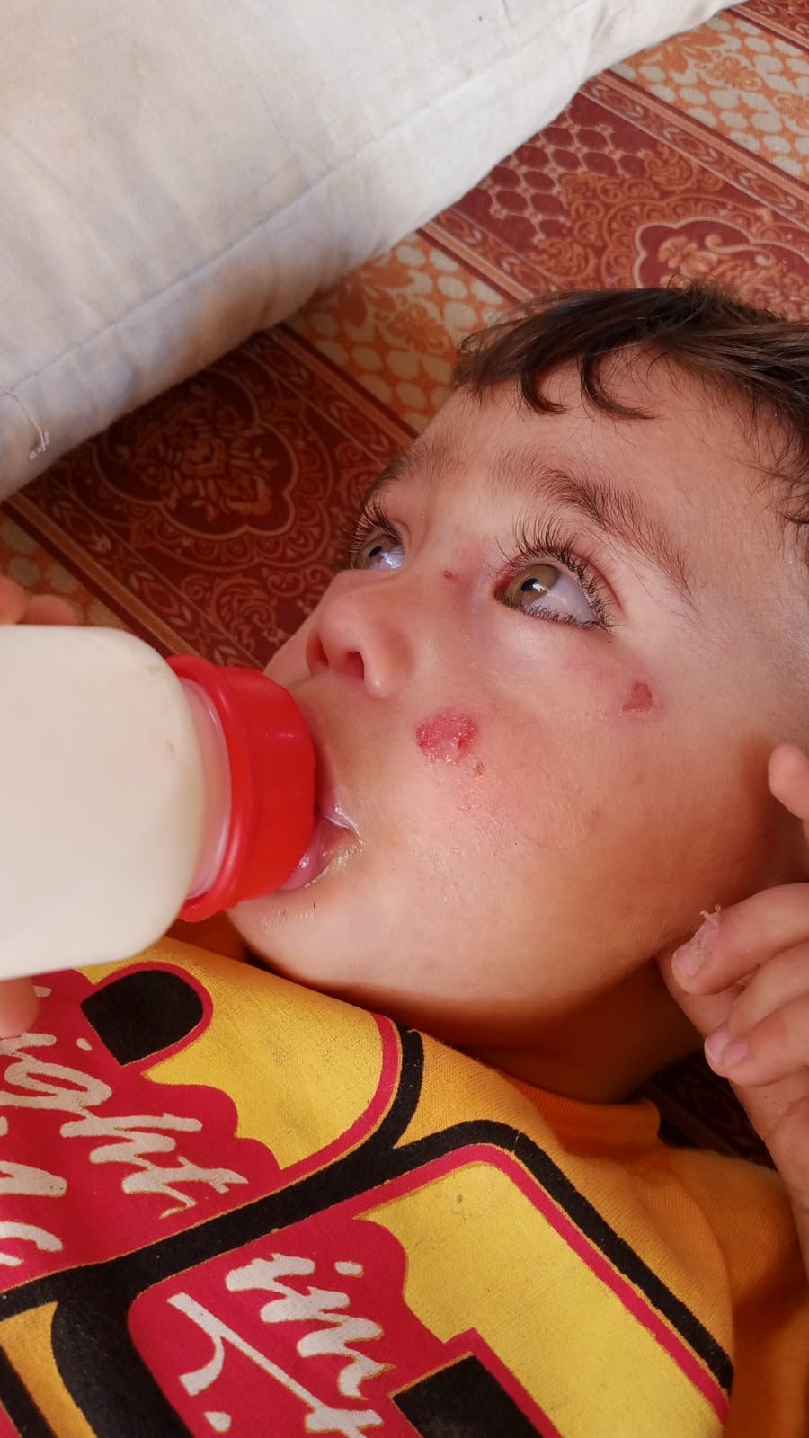 Close-up of a child's face with visible skin sores while drinking from a bottle