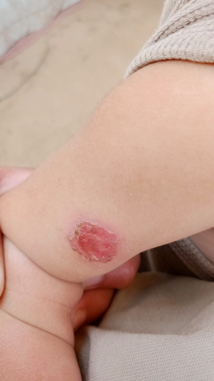 Close-up of an open wound on a child's elbow